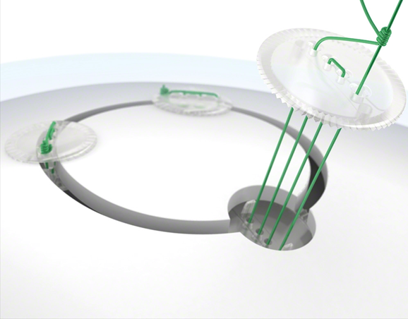 CranioFix resorptivni kranijalna fiksacija Aesculap