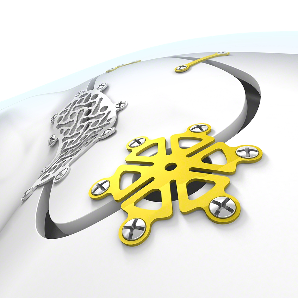 Neuro Plating System Aesculap sistem za kranijalnu fiksaciju